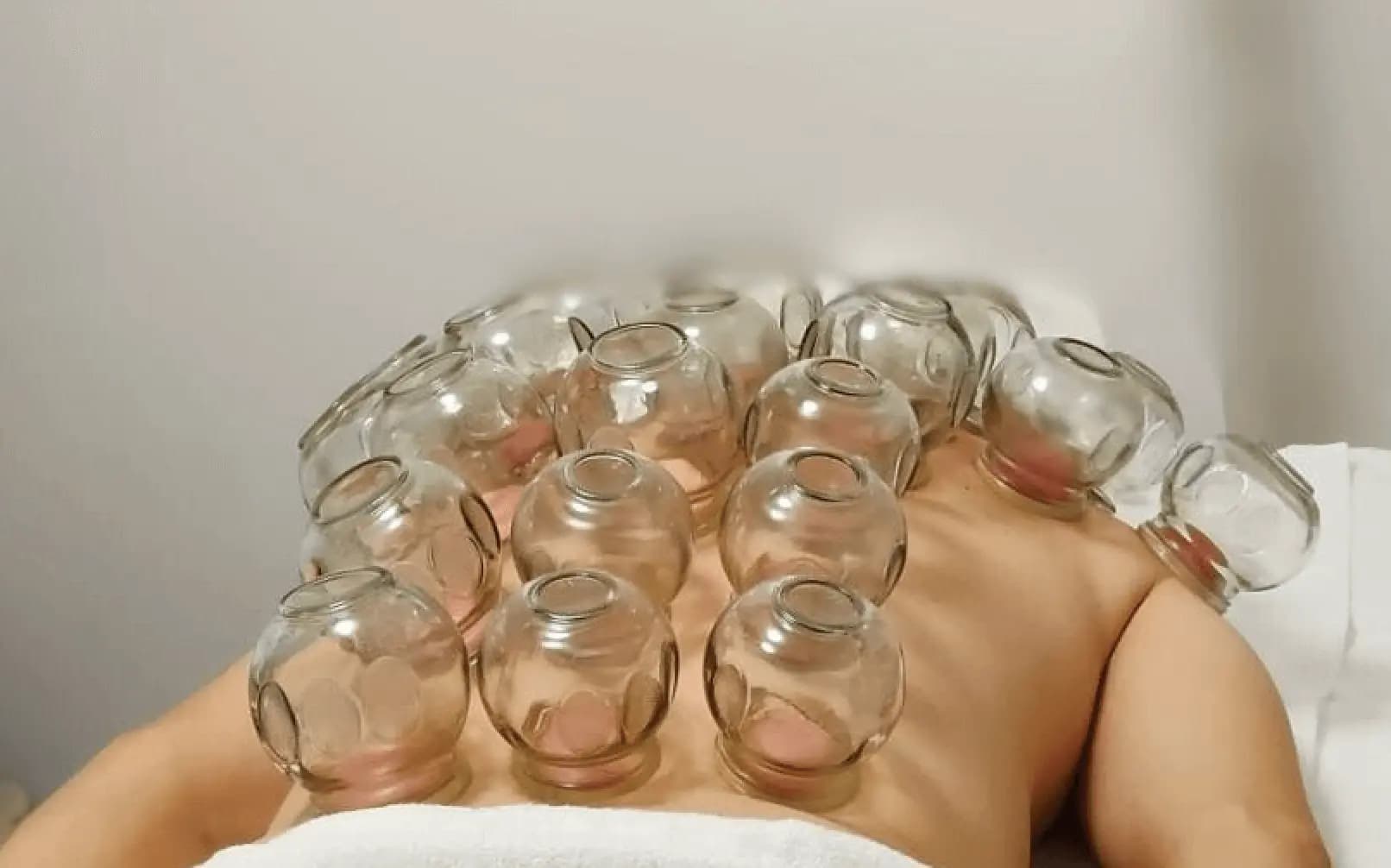 Cupping therapie resultaat